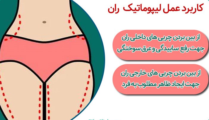 بعد از عمل لیپوماتیک چه کنیم