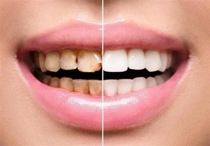 فاکتورهای مهم در نگهداری از سلامت دندانهای لمینت شده