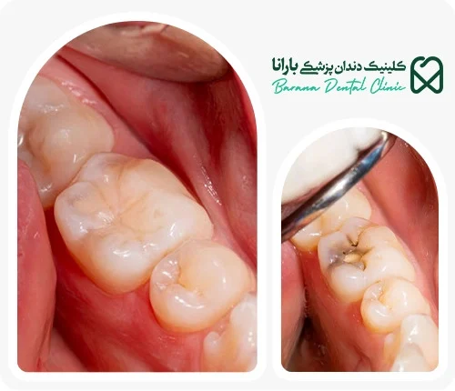مراقبتهای بعد از پرکردن دندان