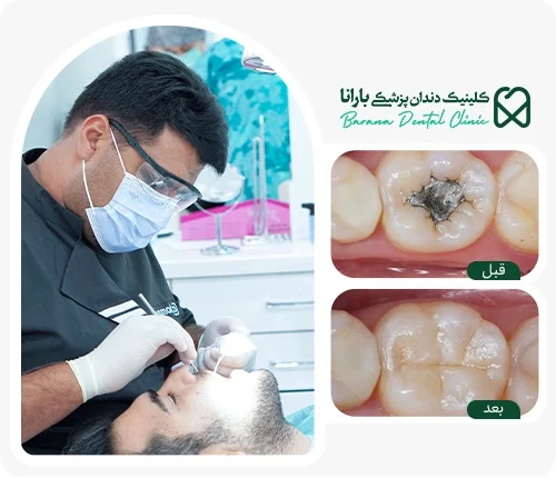 مراقبت های بعد از پر کردن دندان: چه کارهایی نباید انجام داد؟