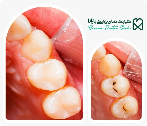 نمونه پرکردن دندان در مشهد